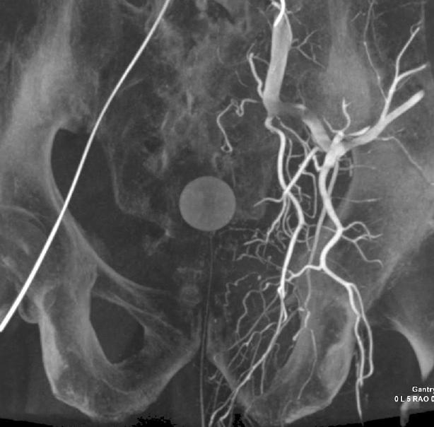 Intra-procedural 3 Dimensional CT Angiogram